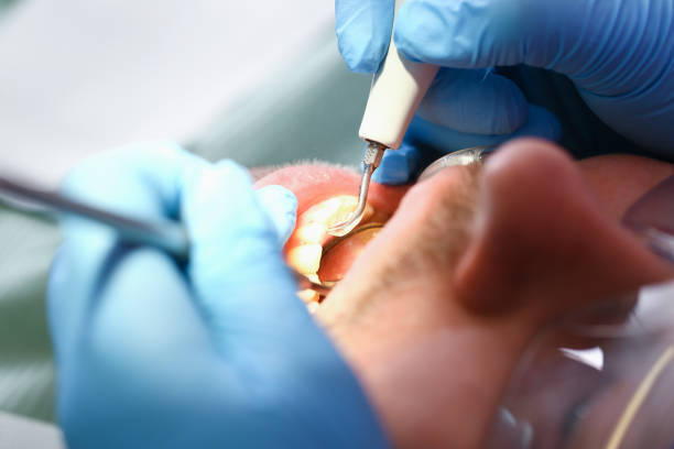 Best Emergency Wisdom Teeth Removal in Castroville, TX